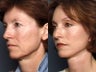 Brow lift