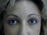 Brow lift