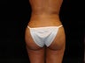 Butt augmentation
