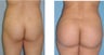 Butt augmentation