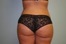 Brazilian butt lift