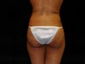 Butt augmentation