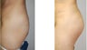 Butt augmentation