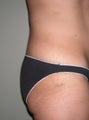 Butt implants