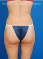 Brazilian butt lift