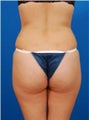 Brazilian butt lift