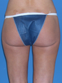 Brazilian butt lift