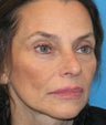 Cheek lift