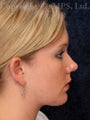 Chin implant