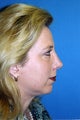 Chin implant