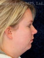 Chin implant