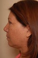 Chin liposuction