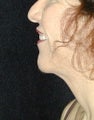 Chin surgery
