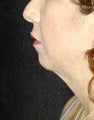 Chin surgery