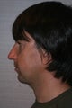 Chin implant