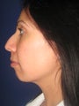 Chin implant
