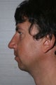 Chin implant