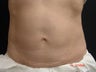 CoolSculpting