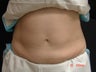 CoolSculpting