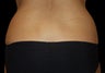 CoolSculpting