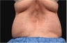CoolSculpting