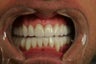 Smile Makeover