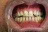 Smile Makeover