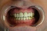 Dental crown