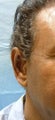 Ear surgery