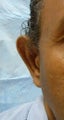 Ear surgery