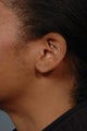 Ear lobe surgery
