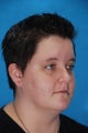 Ear lobe surgery