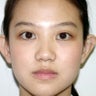 Ear surgery