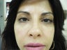 Eye Bags Treatment