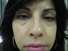 Eye Bags Treatment