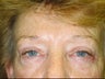 Eyelid Surgery