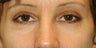 Eyelid Surgery