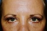Eyelid Surgery