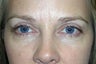 Eyelid Surgery