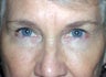 Eyelid Surgery
