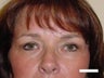Eyelid Surgery