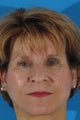 Eyelid Surgery
