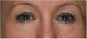 Eyelid Surgery