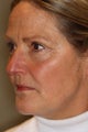 Eyelid Surgery