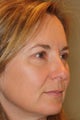 Eyelid Surgery