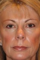 Eyelid Surgery
