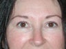 Eyelid Surgery