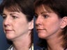 Eyelid Surgery