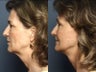 Facelift