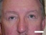 Eyelid Surgery
